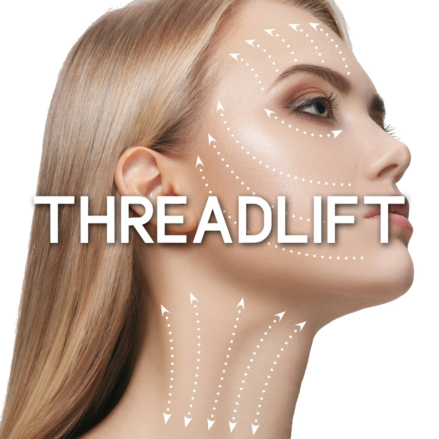 THREADLIFT